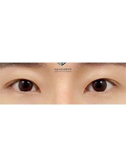 韩国乐于丽颜整形外科做眼整形非常好！眼整形手术图快看！