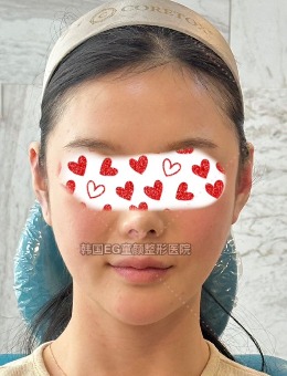 看韩国EG童颜整形医院拯救耳贴面真实对比,get减龄精灵耳！