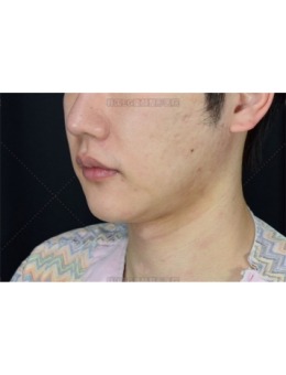 韩国EG童颜怎么样?埋线提升+仪器+注射改善你的跨脸凹嘴和痘坑!_术前