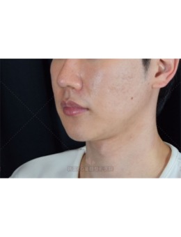 韩国EG童颜怎么样?埋线提升+仪器+注射改善你的跨脸凹嘴和痘坑!_术后