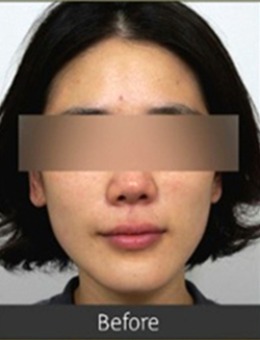 经验分享贴:速看韩国fave皮肤科超声+钛提升抗衰前后对比图!_术前