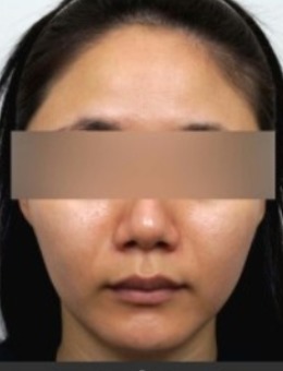 韩国fave皮肤科面部潮红治疗对比！泛红真的得大很大改善！