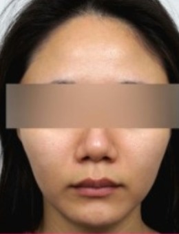 韩国fave皮肤科面部潮红治疗对比！泛红真的得大很大改善！_术后