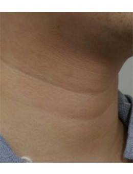 韩国fave皮肤科改善颈纹超绝!利普特拉+填充还你紧致光滑的颈部皮肤~_术前