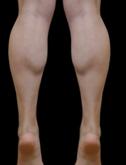韩国jelim整形外科小腿肌肉阻断术太香了！看我的对比！终于没有肌肉腿了_术前