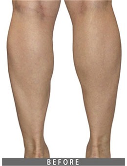 -韩国JELIM整形外科腿型矫正手术太棒了，来看看术后术后对比图！