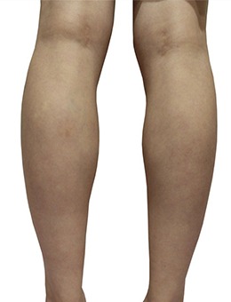 -韩国JELIM整形外科改善你的肌肉腿!让你双腿拥有流畅线条,美美过夏天~