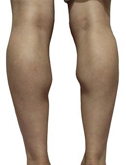 韩国JELIM整形外科改善你的肌肉腿!让你双腿拥有流畅线条,美美过夏天~_术前