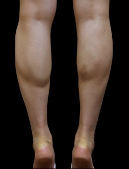 -小腿肌肉发达怎么办?韩国JELIM整形外科做小腿腿型矫正真的超赞!