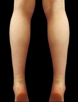 小腿肌肉发达怎么办?韩国JELIM整形外科做小腿腿型矫正真的超赞!_术后