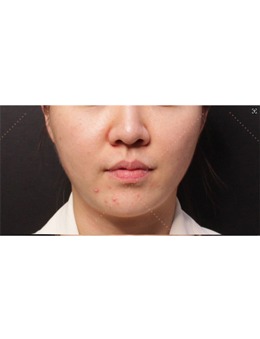 分享我韩国EG童颜皮肤科做超声提升真实经历感受,轻松获得了小V脸!