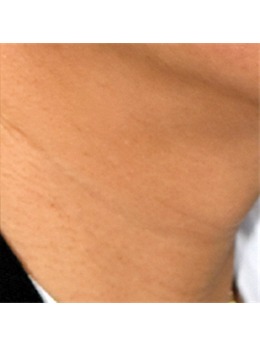 韩国昌皮肤科注射玻尿酸去颈纹技术如何?真人对比图为你解答!