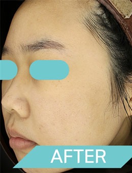 韩国德俊THEJUN皮肤科激光祛痘印前后对比图分享，去除的真干净！
