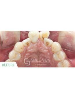 韩国SMILE VIEW牙科牙齿矫正技术太棒了，来看看前后对比图！