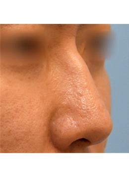 实例分析:韩国昌皮肤科注射隆鼻前后对比告诉你它家技术怎么样!