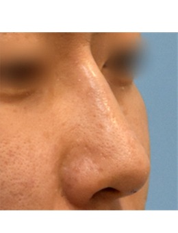 实例分析:韩国昌皮肤科注射隆鼻前后对比告诉你它家技术怎么样!