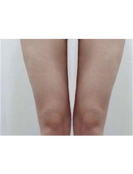 韩国reberry皮肤#2Y*&x*b腿+臀线+膝盖吸脂+Onda提升激光真人实例分享，术后太赞了！