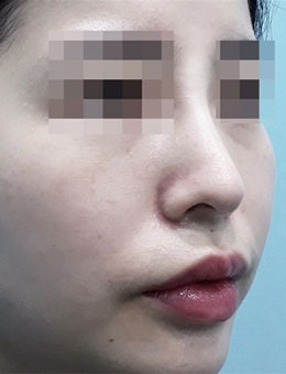 韩国BIOFACE皮肤科玻尿酸隆鼻前后对比图，真的很惊艳！