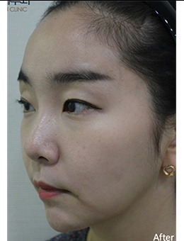 跨脸救星!韩国EVER皮肤科超声提升+面填让你