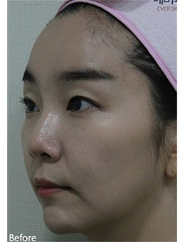 跨脸救星!韩国EVER皮肤科超声提升+面填让你