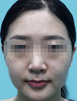 韩国BIOFACE皮肤科的医美镭射激光祛斑/美白/收缩毛孔是真的好,不信来看对比!_术前
