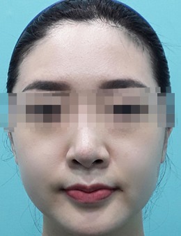 韩国BIOFACE皮肤科的医美镭射激光祛斑/美白/收缩毛孔是真的好,不信来看对比!_术后