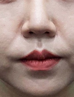 韩国BIOFACE皮肤科去法令纹照片分享，前后对比很明显！_术前