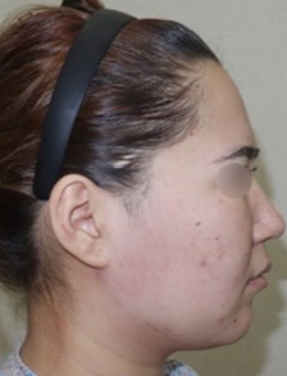 【绮林整形外科】适合与面部轮廓手术同时进行的手术方法和下颌角手术前后对比