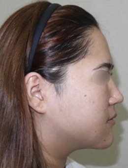 【绮林整形外科】适合与面部轮廓手术同时进行的手术方法和下颌角手术前后对比_术后