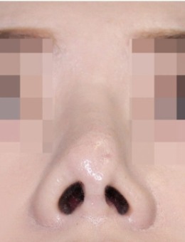 鼻尖塌陷下垂修复手术前后照片！绮林整形做鼻修复确实有实力！_术前