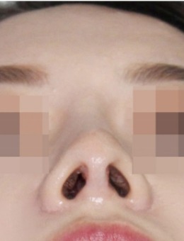 鼻尖塌陷下垂修复手术前后照片！绮林整形做鼻修复确实有实力！_术后