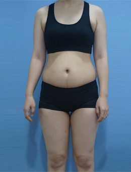 韩国BIOFACE皮肤科腰腹身体提升记录：重塑曲线，绽放美丽!_术前