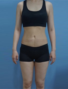 韩国BIOFACE皮肤科腰腹身体提升记录：重塑曲线，绽放美丽!_术后