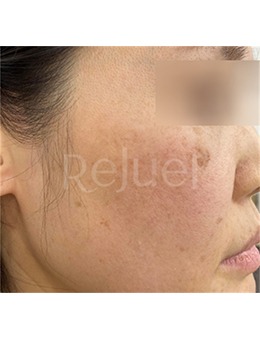 告別色斑暗沉!韓國Rejuel Clinic 東城路