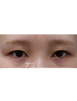 清潭es整形外科雙眼皮手術(shù)實例分享，自然放大雙眼還修復(fù)期短!