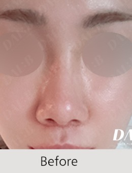 韓國Dal:B整形外科做鼻子好看，真實(shí)對比圖告訴你有多精致！