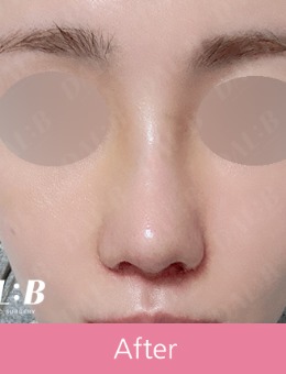韓國Dal:B整形外科做鼻子好看，真實(shí)對比圖告訴你有多精致！