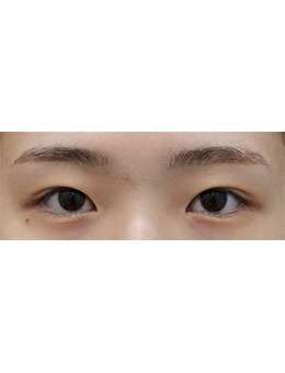 韓國清潭es整形外科雙眼皮手術(shù)真的贊,放大雙眼比例自然又靈動(dòng)!