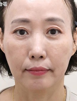 韓國(guó)selfi整形外科埋線提升手術(shù)前后對(duì)比圖公開(kāi)，術(shù)后真的很顯年輕！