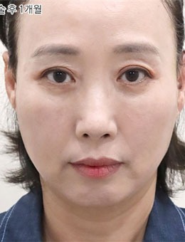韓國(guó)selfi整形外科埋線提升手術(shù)前后對(duì)比圖公開(kāi)，術(shù)后真的很顯年輕！