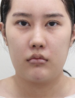 韓國selfi整形外科雙下巴改善實(shí)例分享:想要精致輪廓,先看下我的變化!