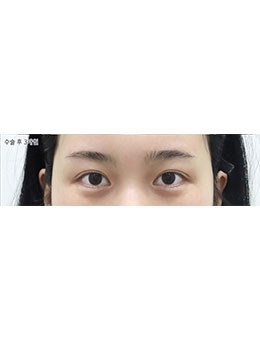韓國(guó)selfi整形外科眼部手術(shù)前后對(duì)比照，術(shù)后眼睛更有神韻一點(diǎn)不夸張！