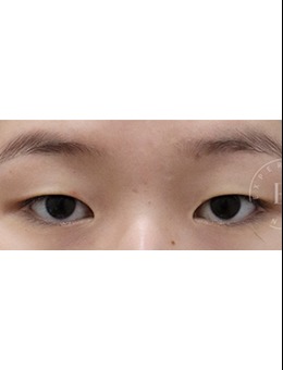 單眼皮到雙眼皮的蛻變，韓國清潭ES醫(yī)院做雙眼皮真不錯！