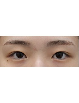 內(nèi)雙眼皮怎么變外雙，清潭ES醫(yī)院有辦法，這個案例分享給你！