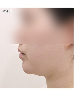 去韓國Selfi醫(yī)院做雙下巴后怎么樣了？那是好看又自然！一個對比圖讓你看到變化在哪里！