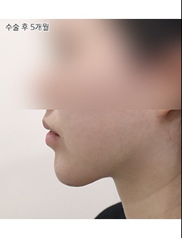去韓國Selfi醫(yī)院做雙下巴后怎么樣了？那是好看又自然！一個對比圖讓你看到變化在哪里！