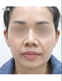 在韓國(guó)Selfi醫(yī)院做了法令紋，這也太自然好看了吧！看看這對(duì)比圖，不說(shuō)你知道填了法令紋嗎？