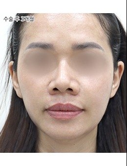 在韓國(guó)Selfi醫(yī)院做了法令紋，這也太自然好看了吧！看看這對(duì)比圖，不說(shuō)你知道填了法令紋嗎？