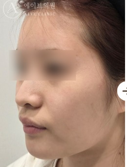 韓國aive皮膚科提拉+超聲復合抗衰3周后下頜線提升變化實例分享!