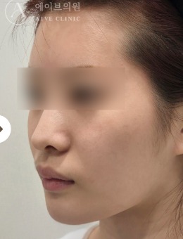 韓國aive皮膚科提拉+超聲復合抗衰3周后下頜線提升變化實例分享!